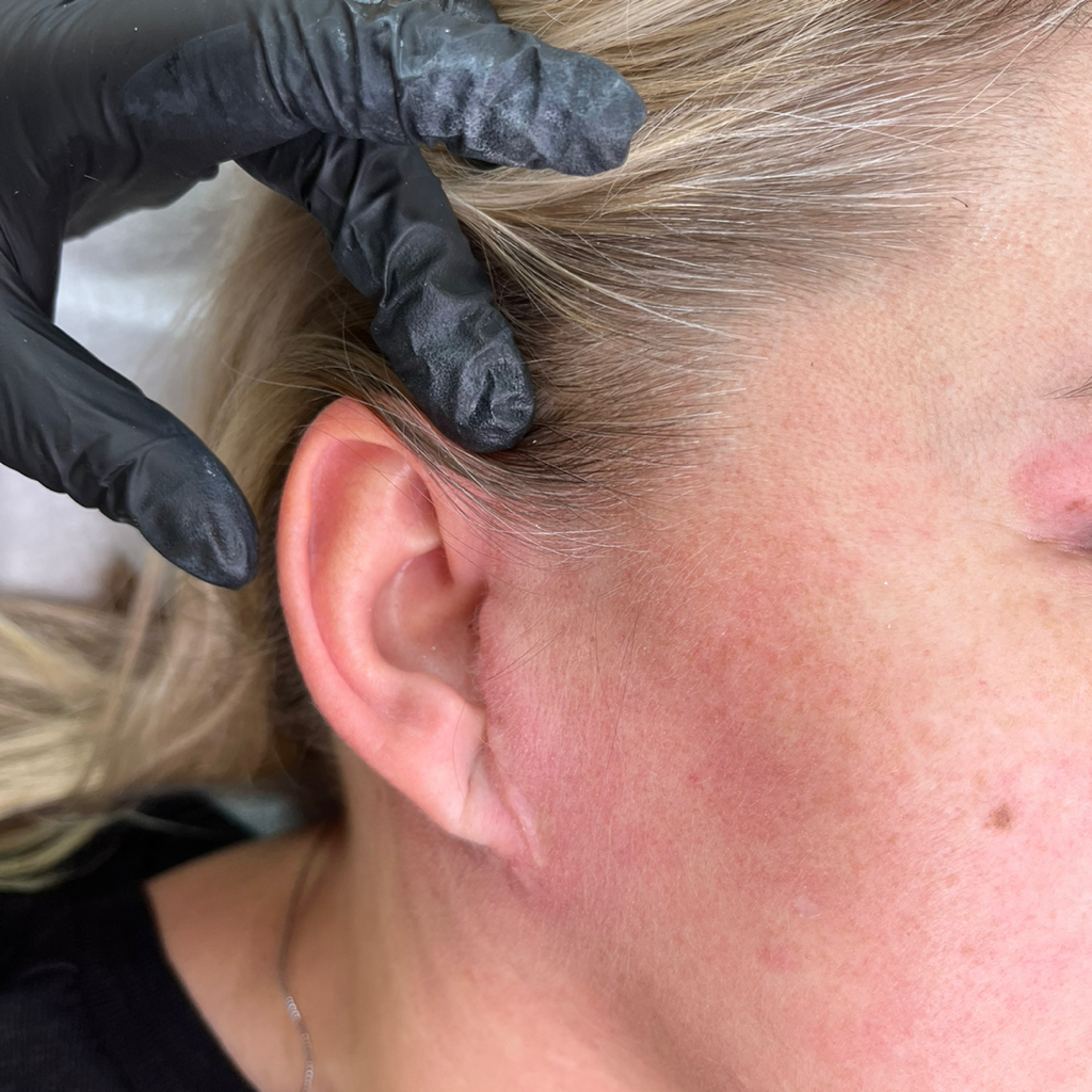 Камуфляж рубцов и шрамов