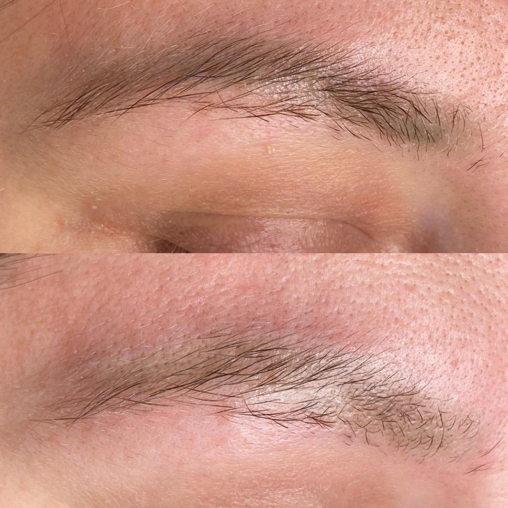 Ремувер удаление пигмента