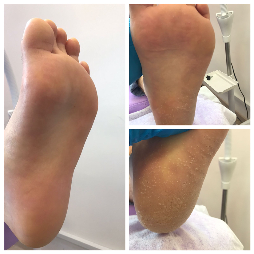 Педикюр без покрытия ( только обработка стопы и кутикулы)