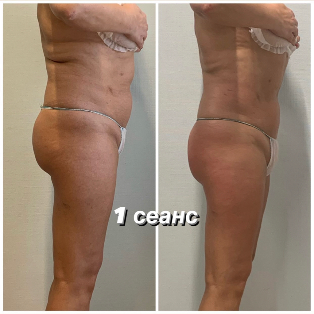 Липомоделирование тела