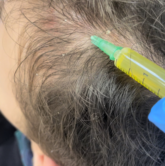 Плазмотерапия кожи головы