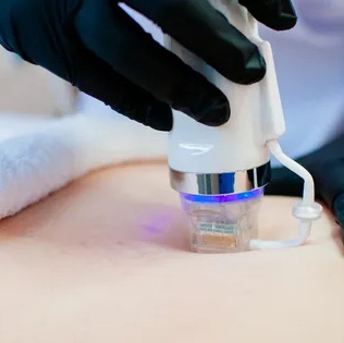 Фракционный игольчатый Rf-лифтинг (шея)