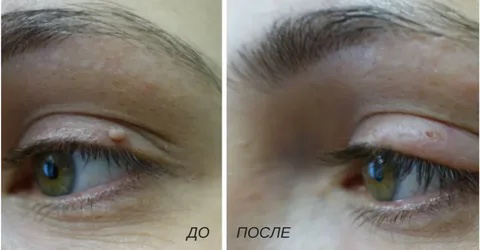 Удаление папилом