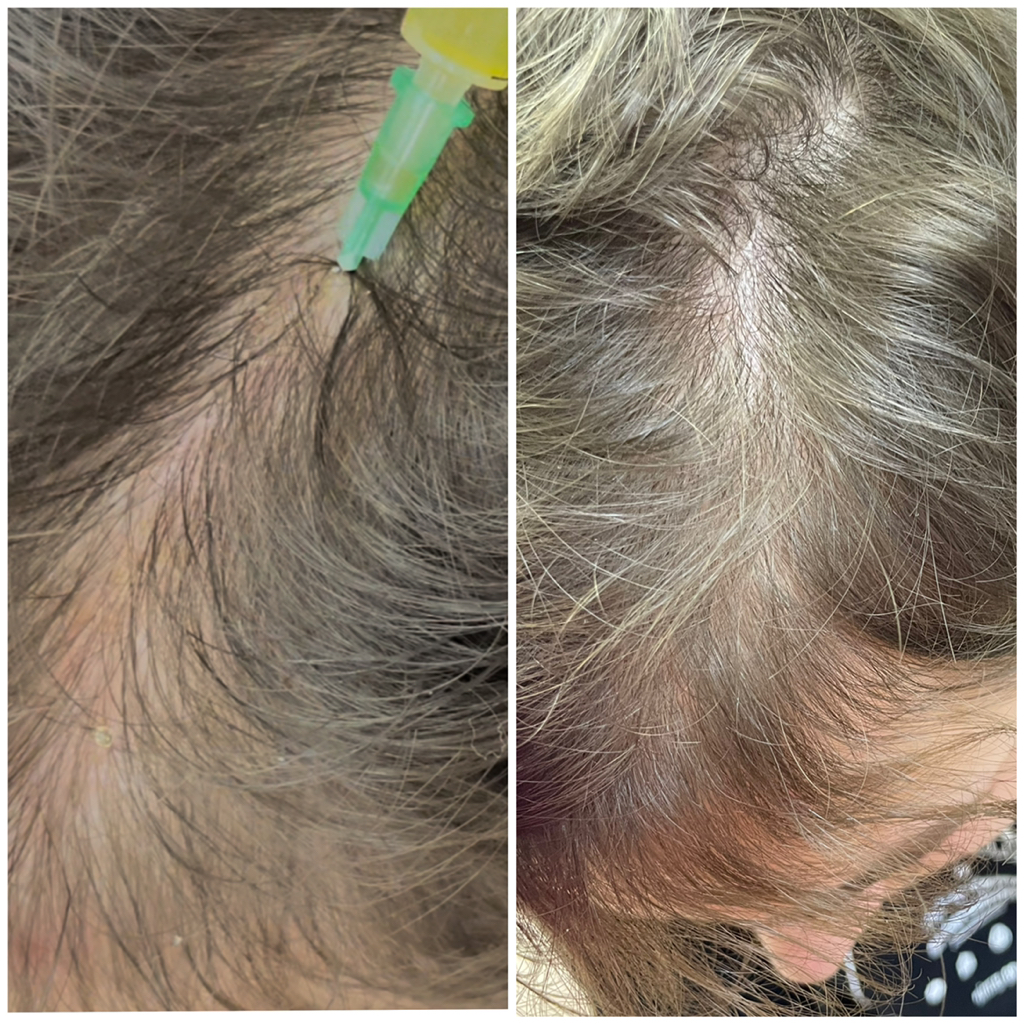 Мезотерапия кожи головы