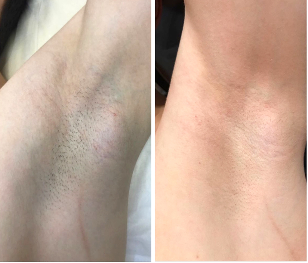 Лазерная Эпиляция подмышки