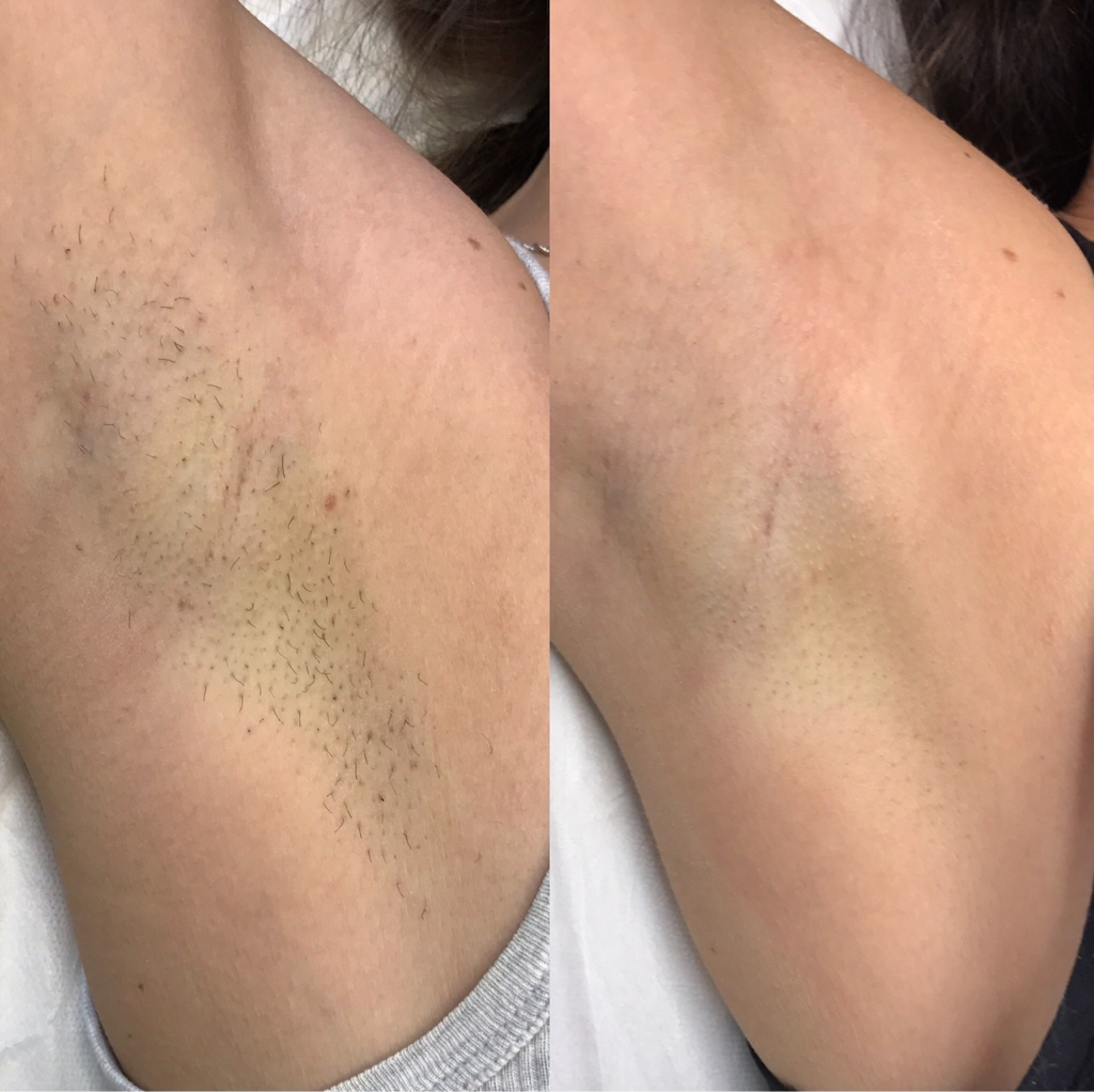 Лазерная эпиляции глубокое бикини