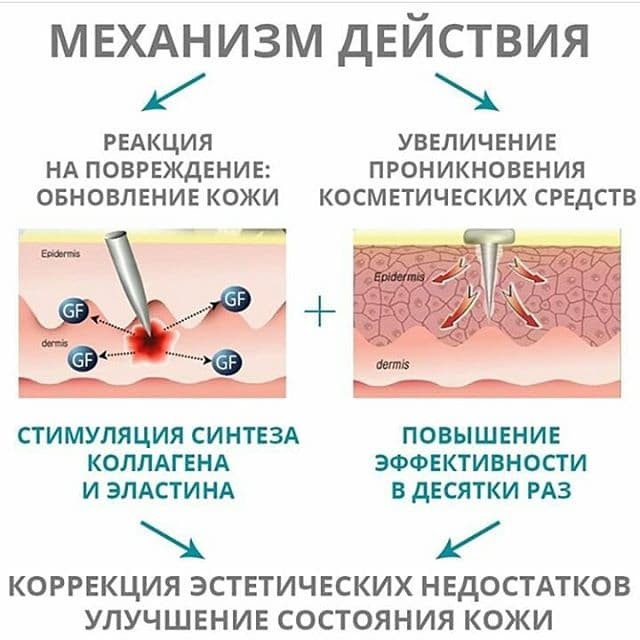 Микронидлинг