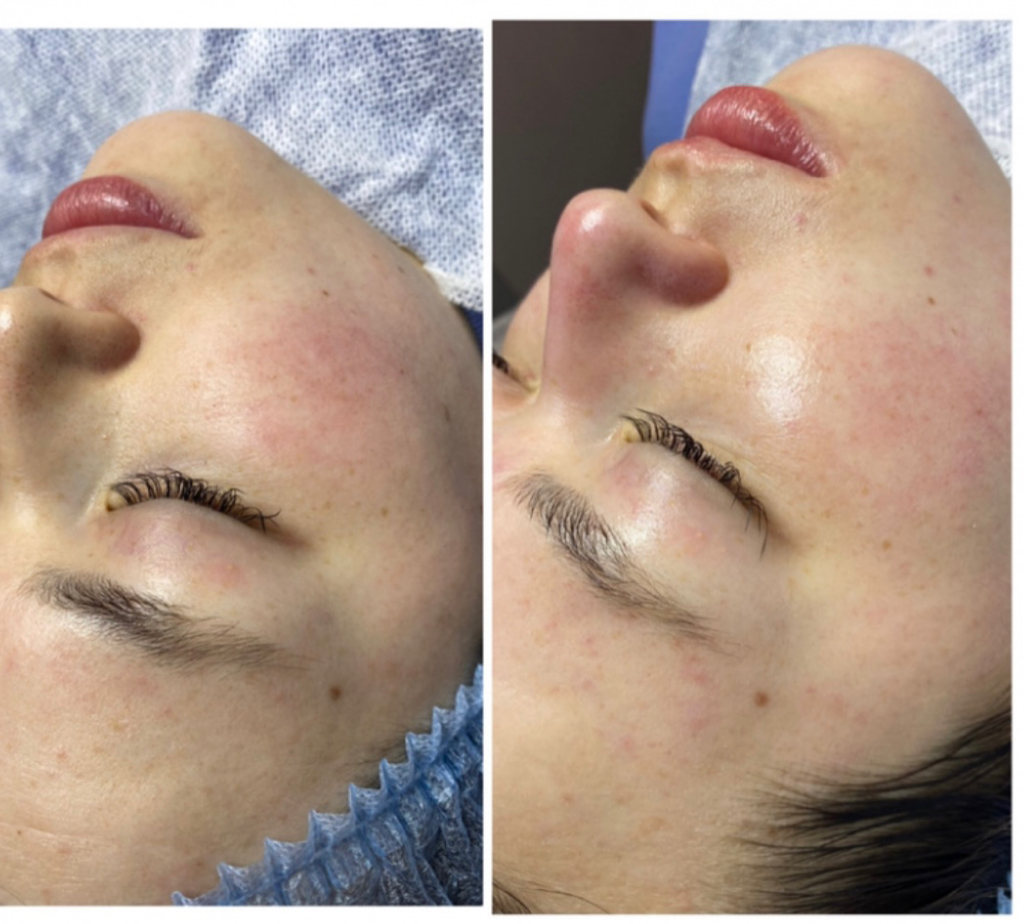 Чистка +пилинг BIOREPEEL