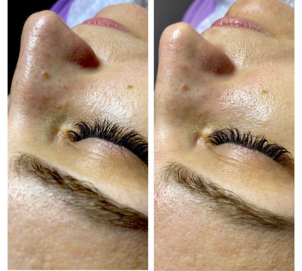 Чистка + карбокситерапия