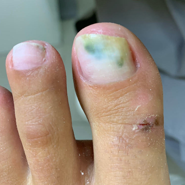 Сложный педикюр: обработка пальчиков + зачистка онихолизиса/онихомикоза 1-2шт