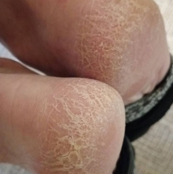 Сложный педикюр: обработка стопы с трещинами