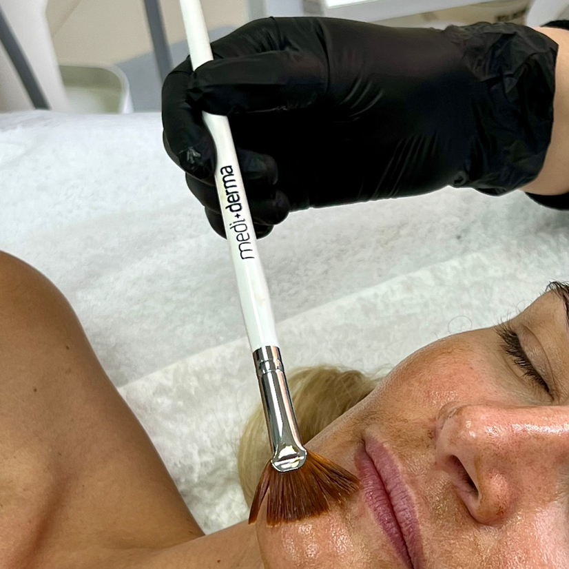 Молочный пилинг