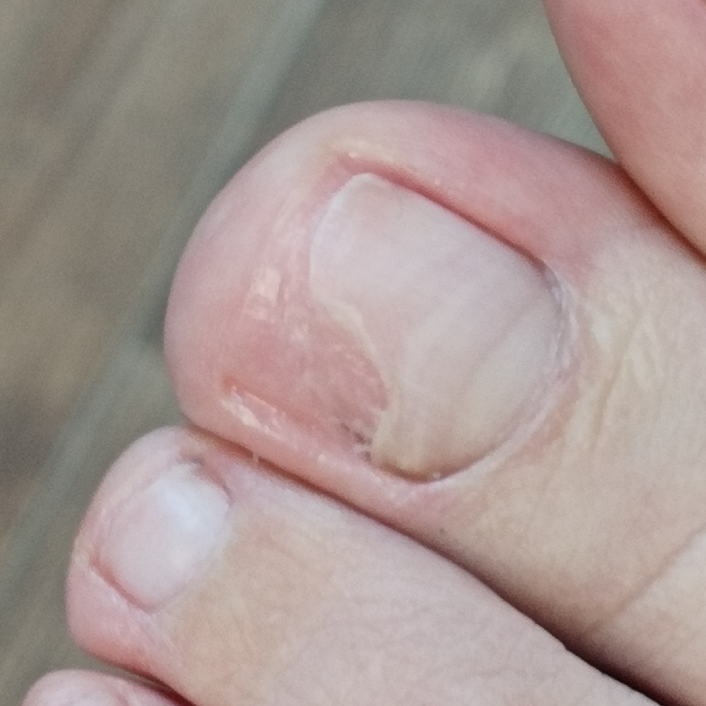 Обработка одного измененного ногтя на ноге