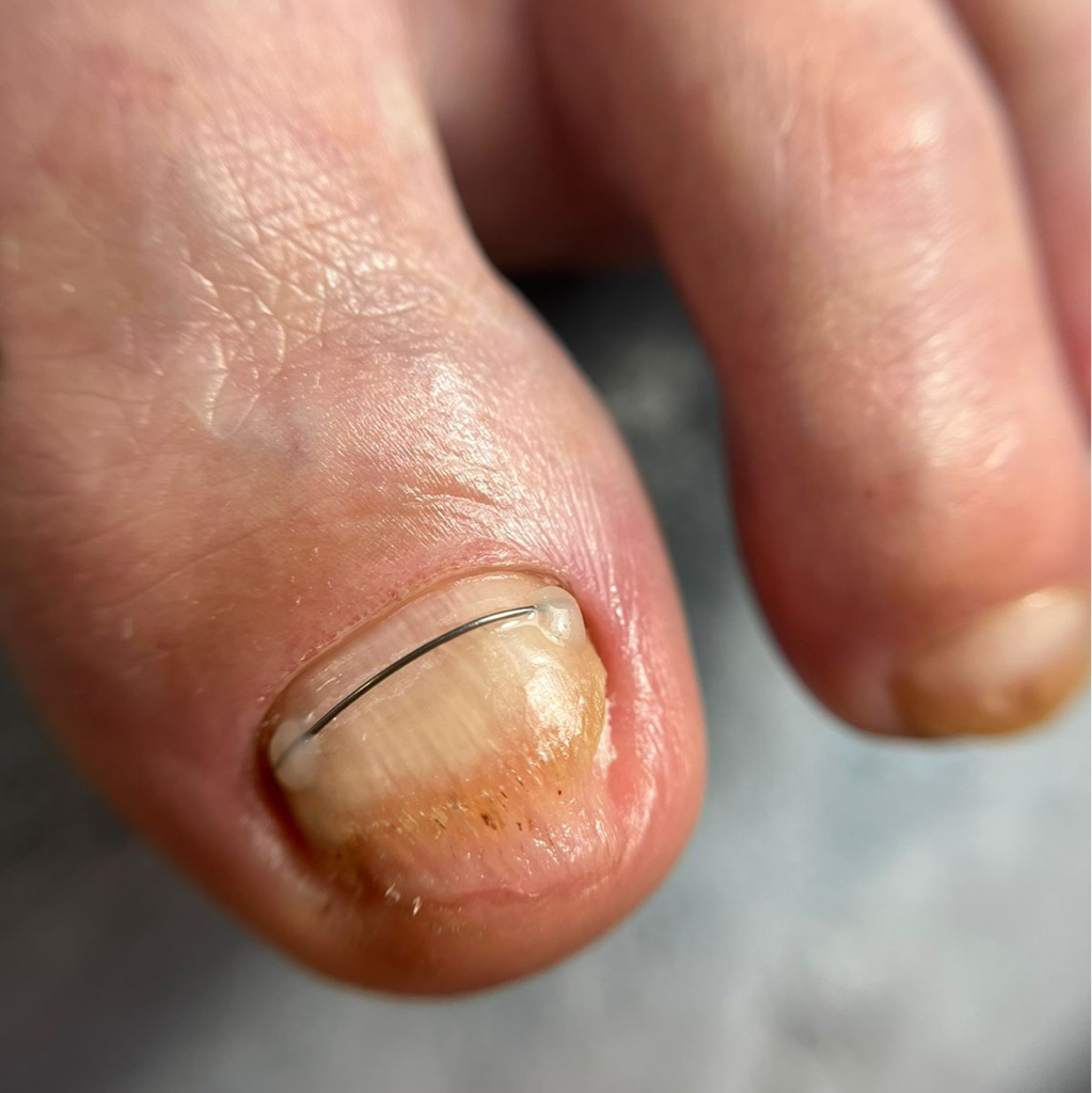 ПЕРВИЧНЫЙ КОМПЛЕКСНЫЙ ПЕДИКЮР СЛОЖНАЯ СТОПА(Онихомикоз,онихолизис,мозоли,трещины и др)