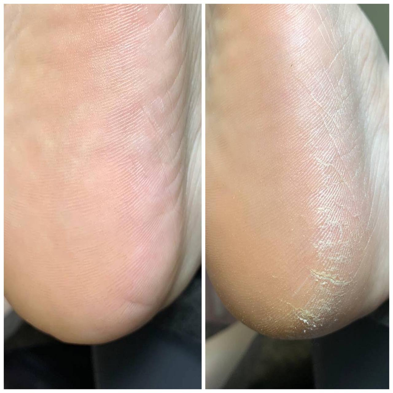 Педикюр обработка стопы