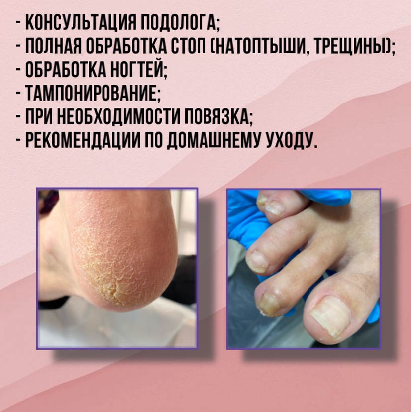 Обработка 1 степени сложности подологом