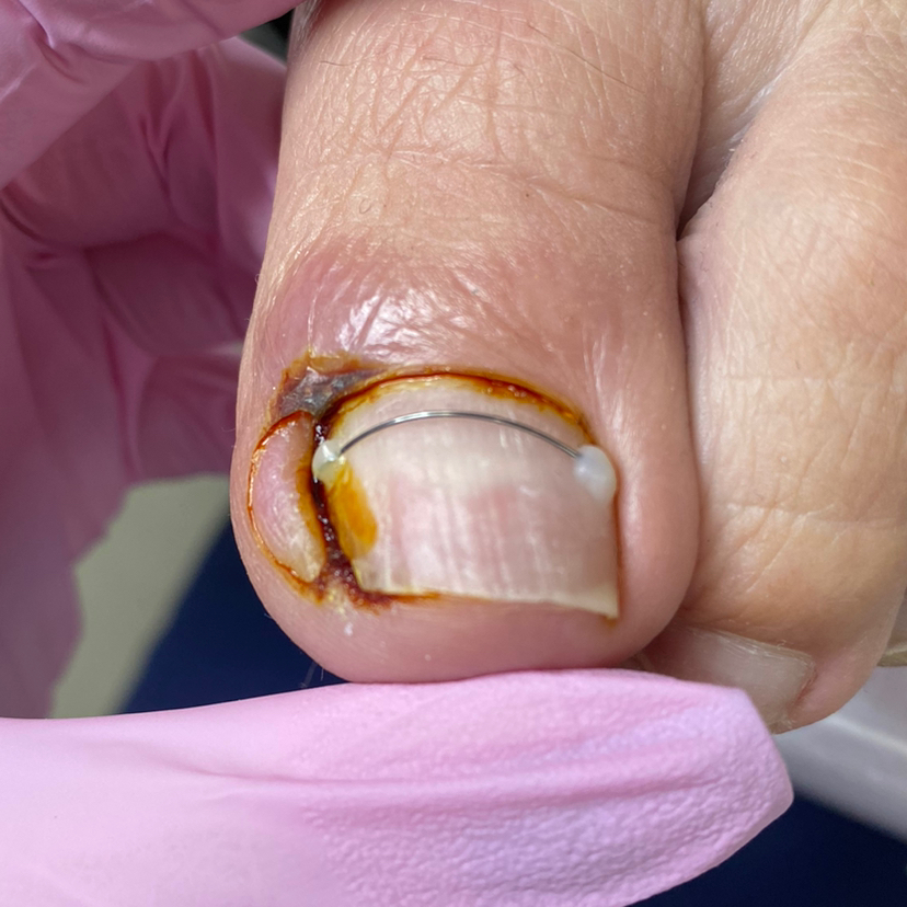 Работа с вросшим ногтем.