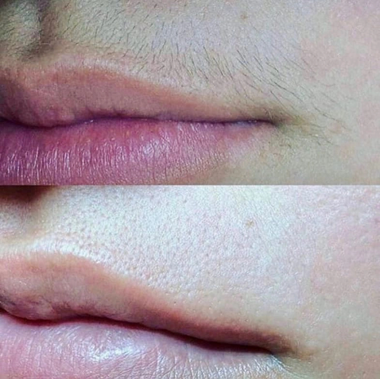 Коррекция усиков воском