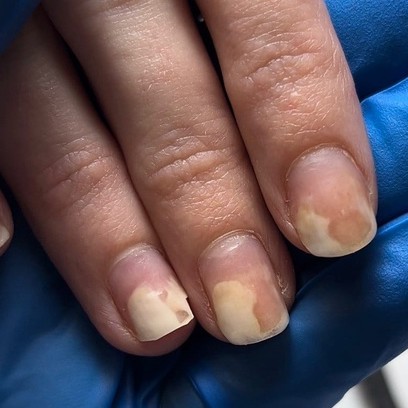 Медицинский маникюр