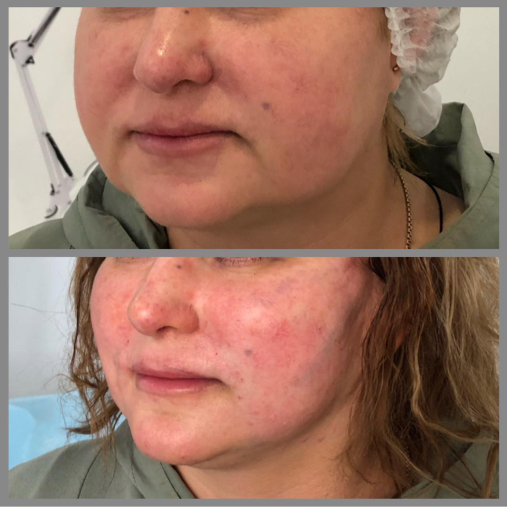 Лифтинг лица нитями