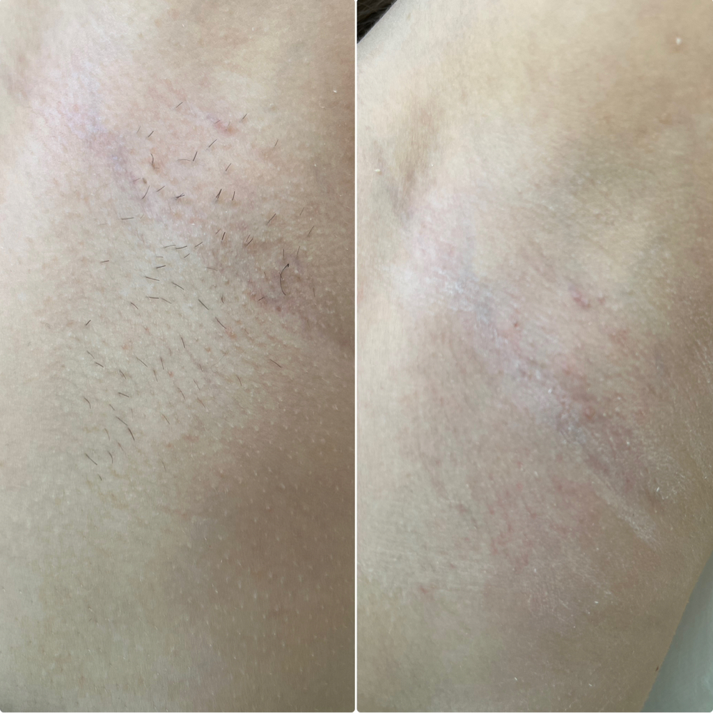 Подмышечные впадины