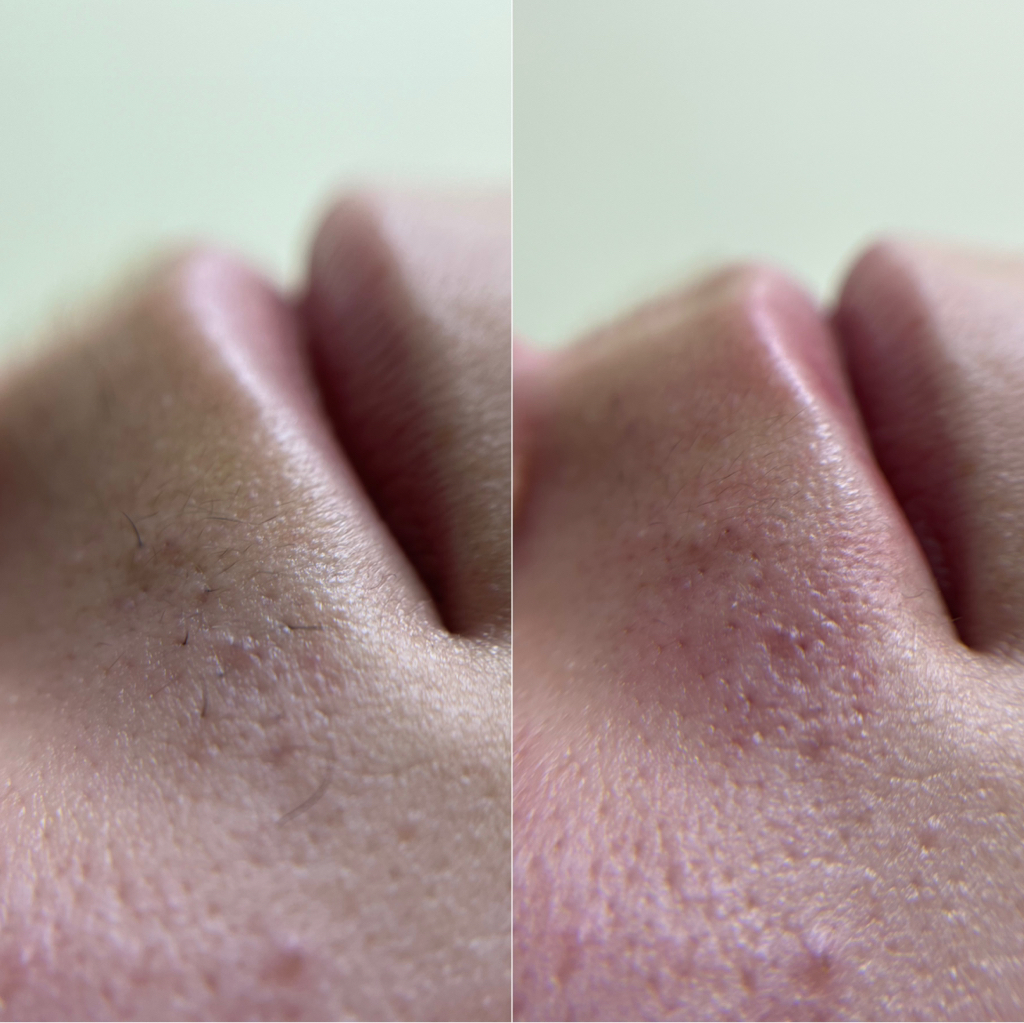 Верхняя губа