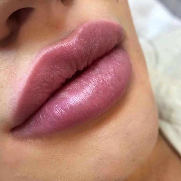 Аугментация губ