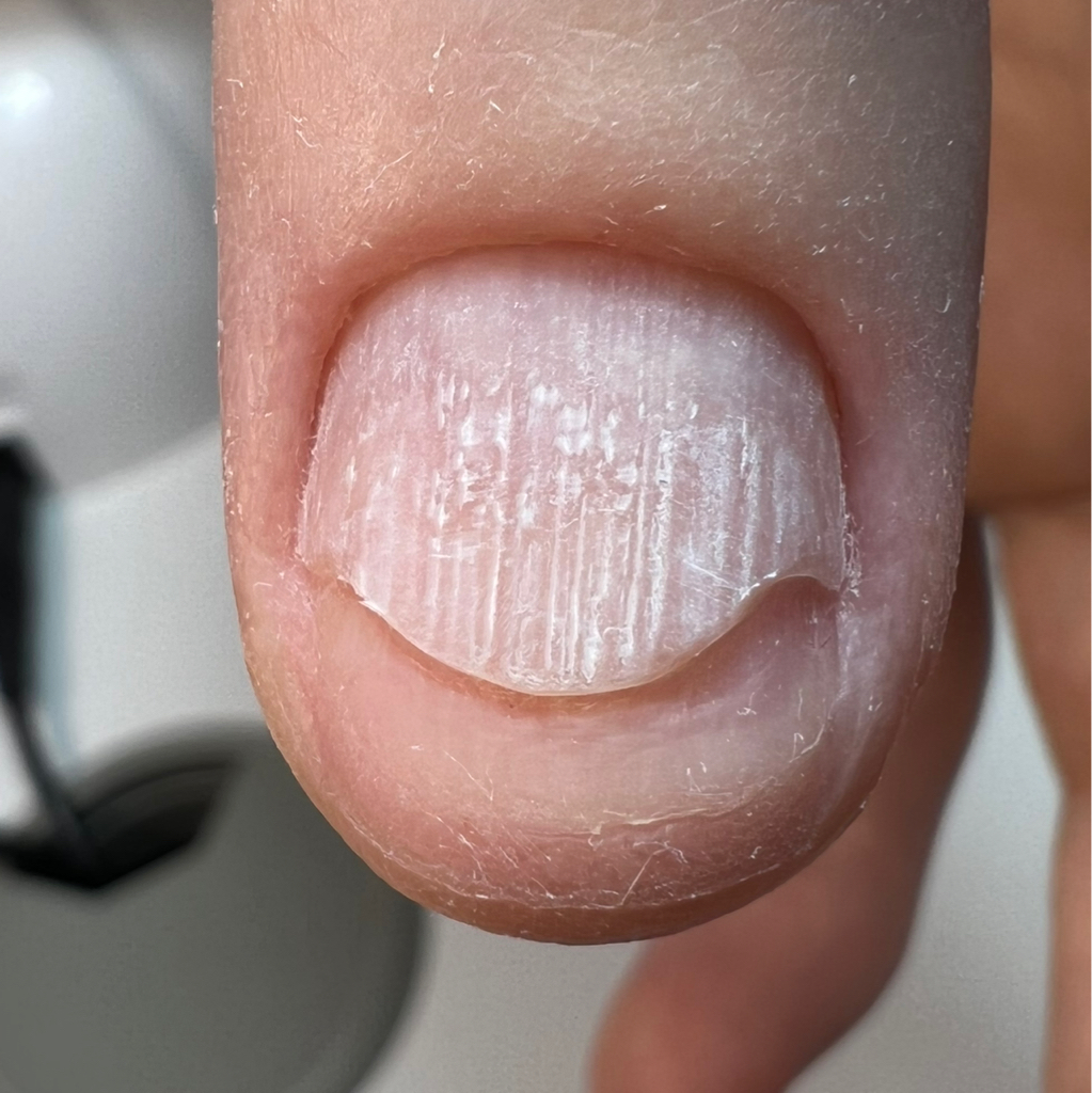 Онихолизис Зачистка