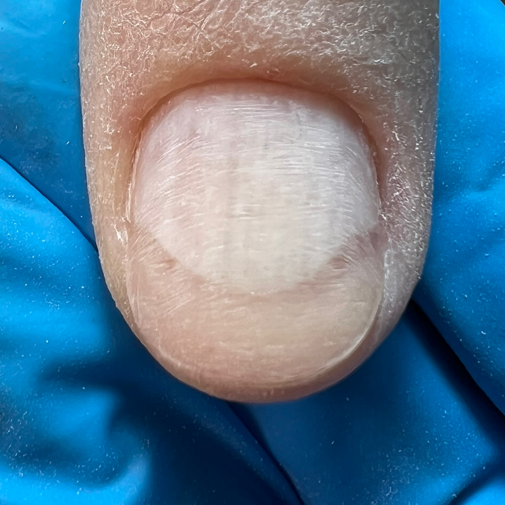 Протезирование Ногтя (при Онихолизисе)