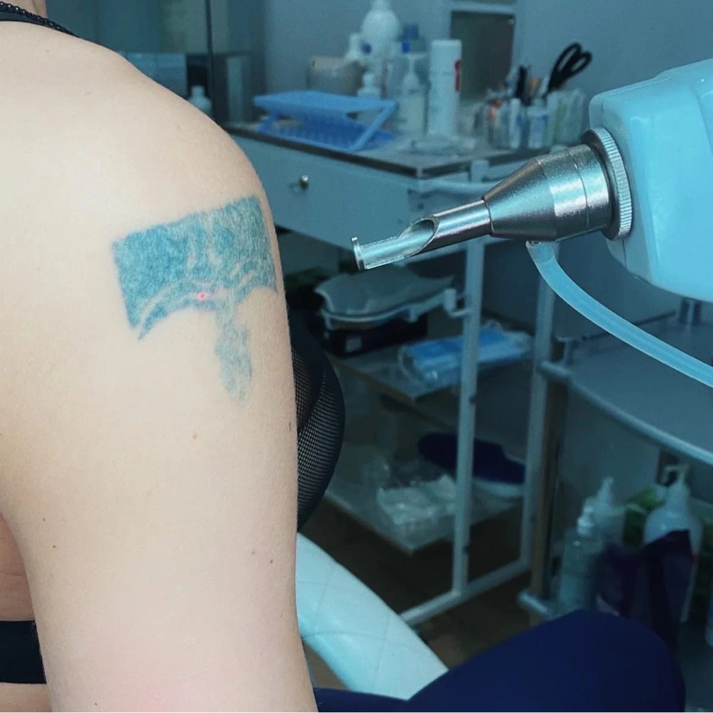 Удаление татуировок