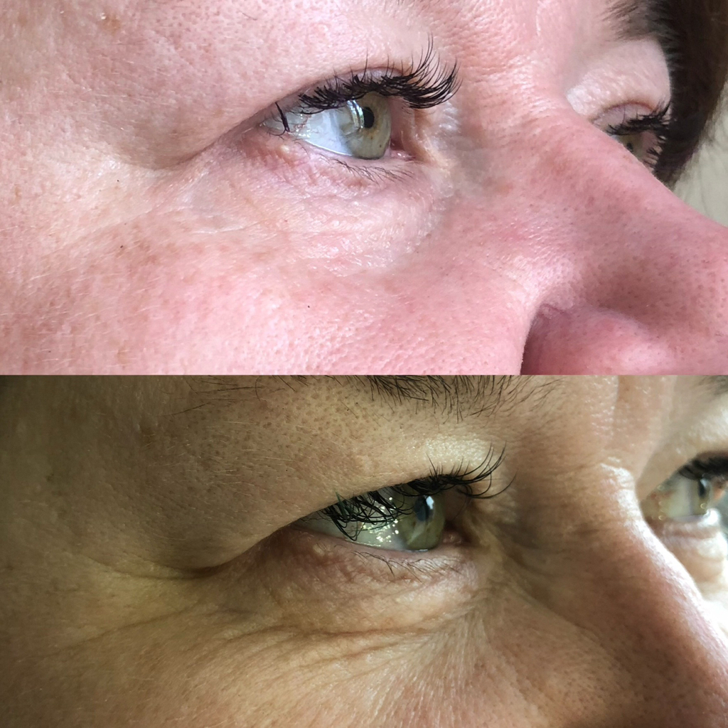 безоперационная блефара аппаратом «Pilsar»