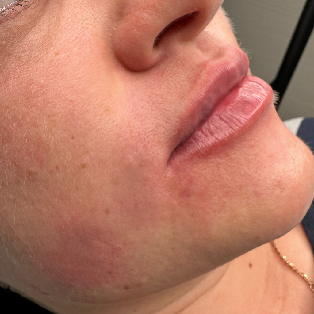 Носогубная складка( контурная пластика )