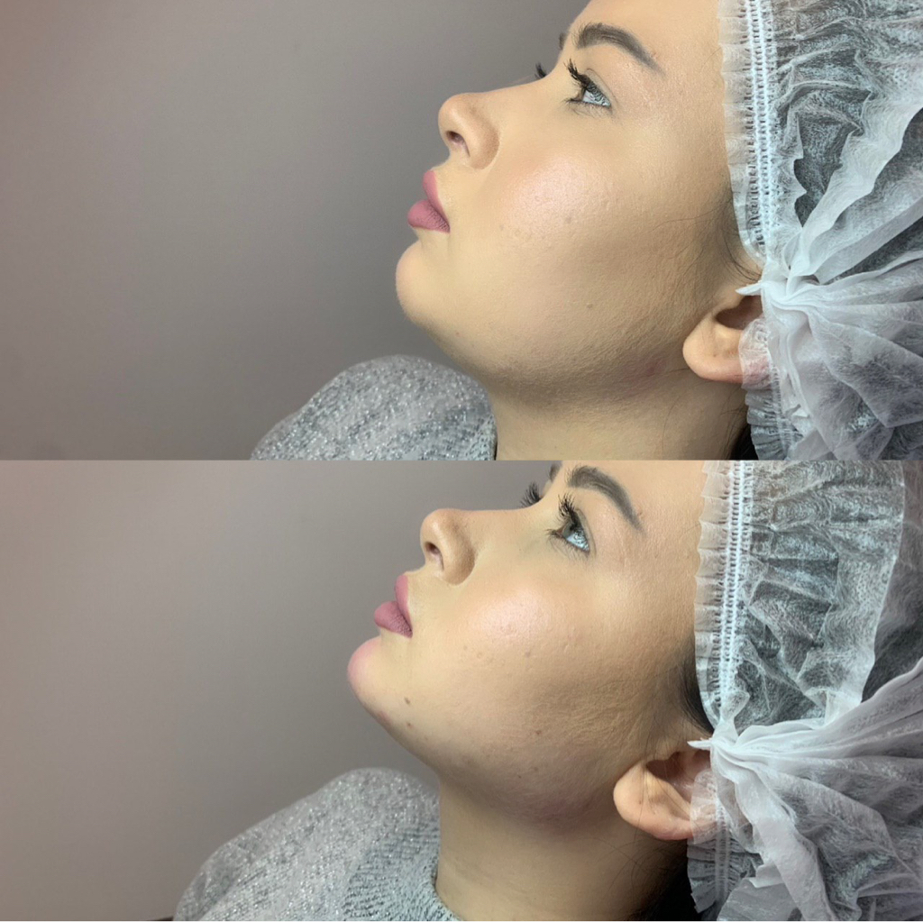 Процедура худое лицо( Корея )