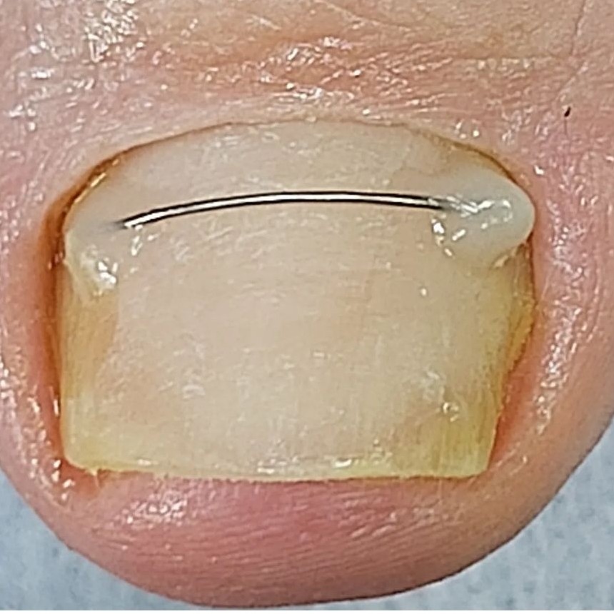 Титановая нить /Установка коррекционной системы /1 шт