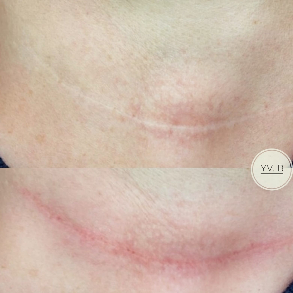 Камуфляж шрама,ожога,рубца