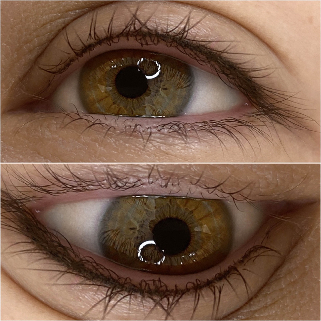 Межресничное заполнение