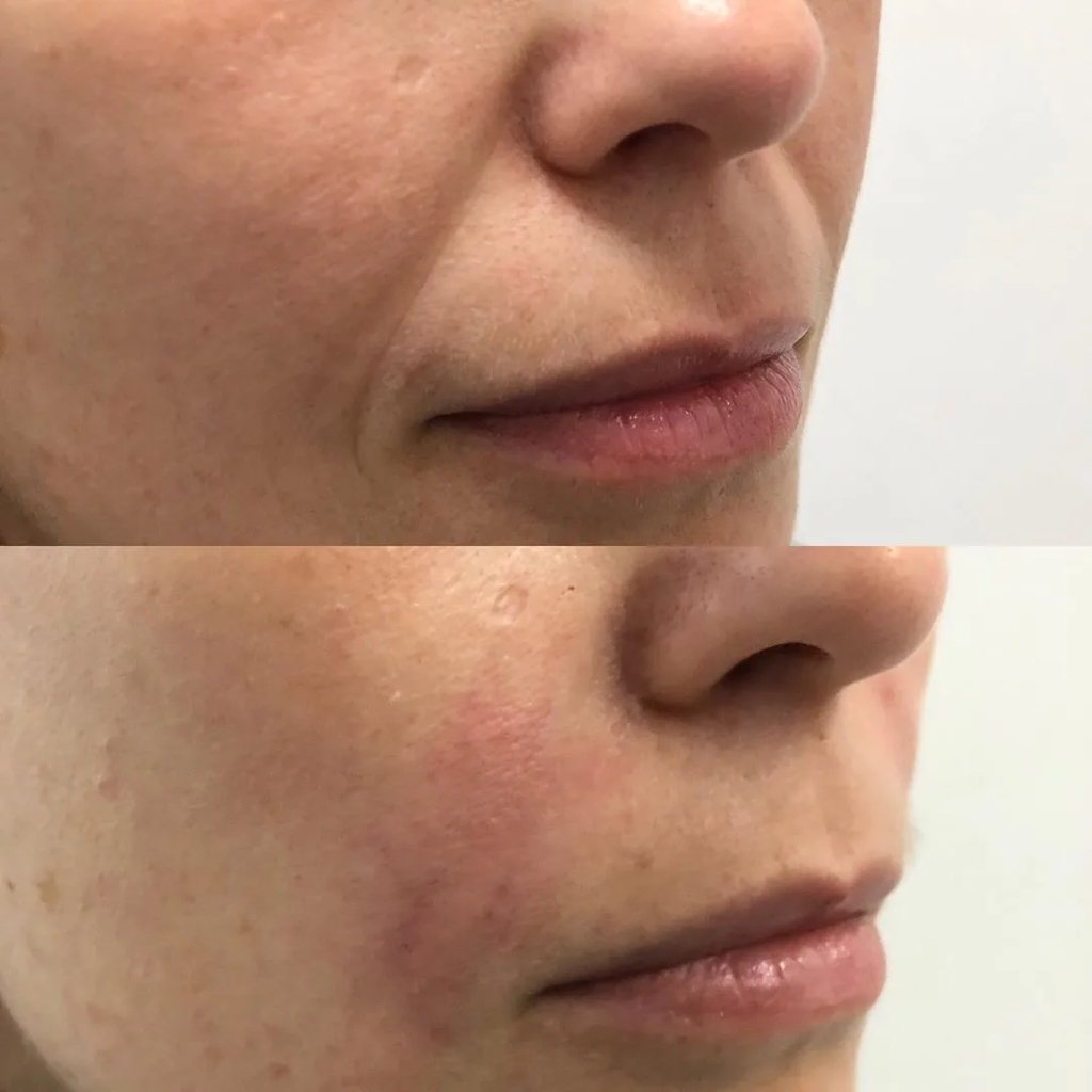 Коррекция носогубных заломов