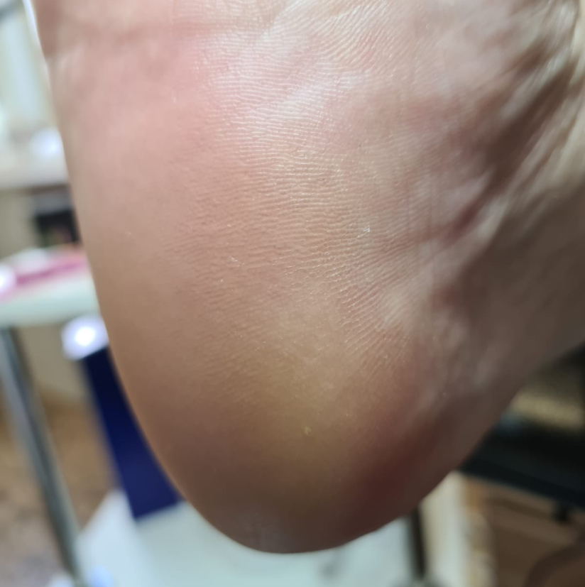 Педикюр обработка стопы