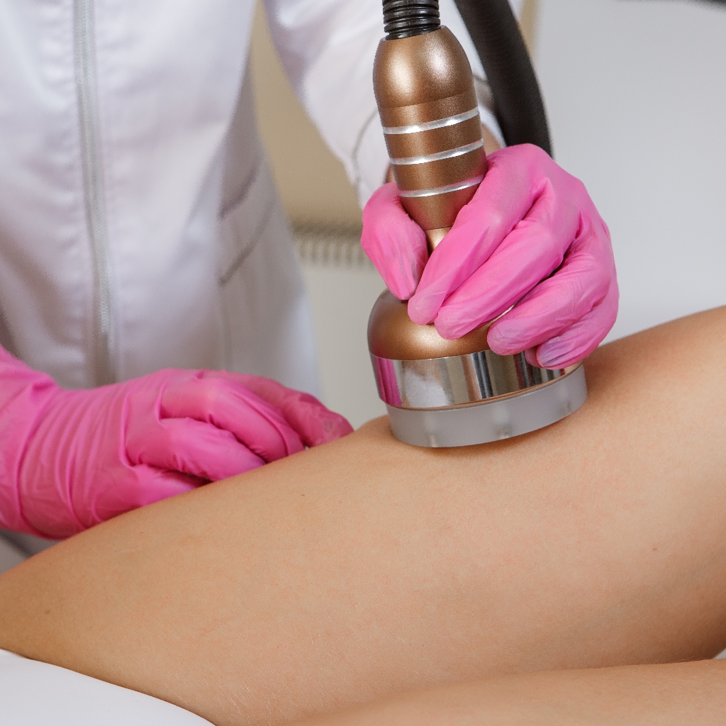 RF лифтинг тела