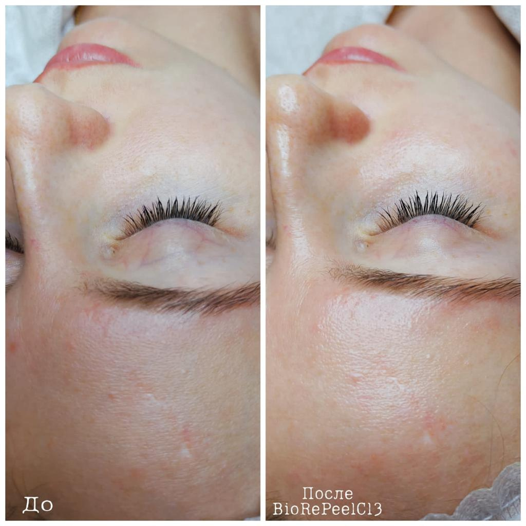 Поверхностный пилинг для лица