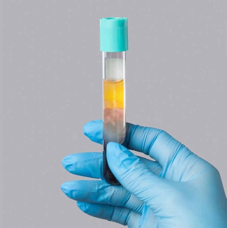 Плазмотерапия (PRP) 1