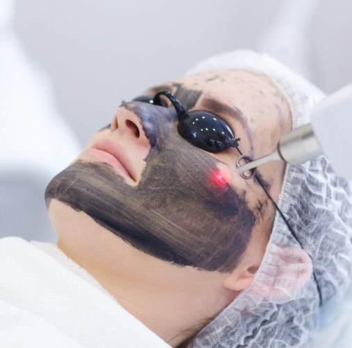 Карбоновый пилинг