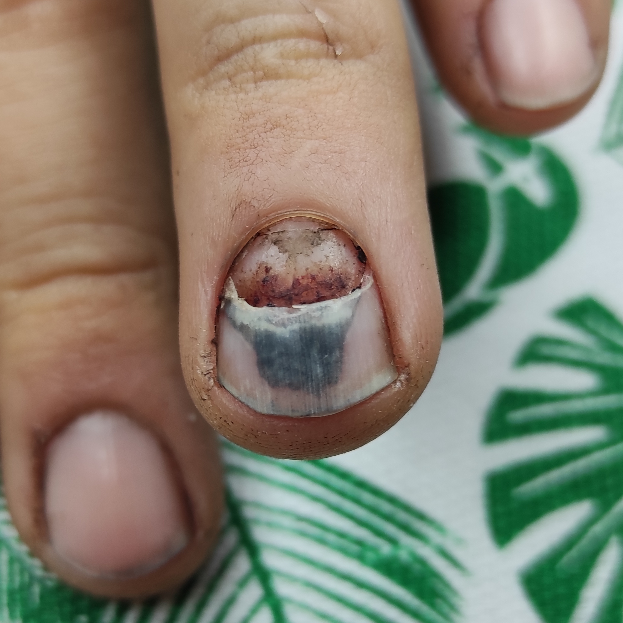 Обработка онихолизиса, онихогрифоза или микоза на руках 1 ноготь