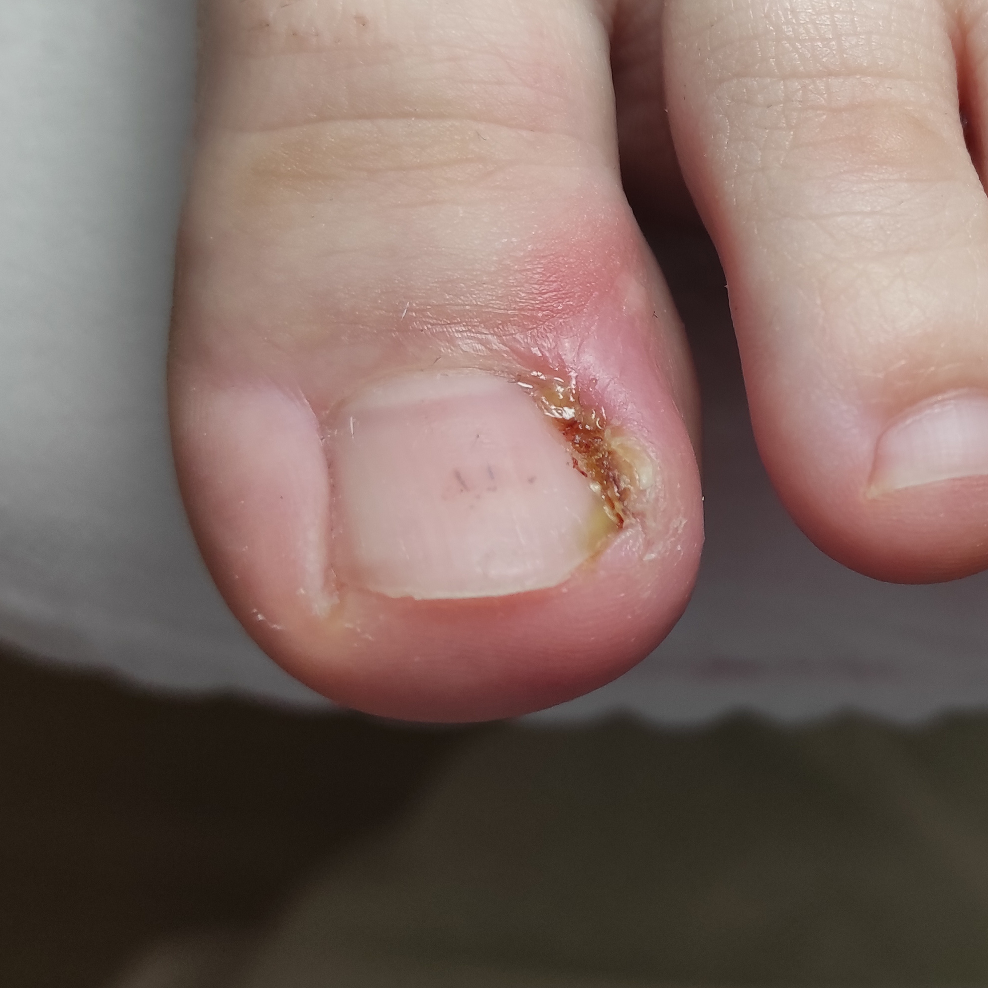 Обработка вросшего или сорванного ногтя с раневым процессом или гематомой 1 ноготь