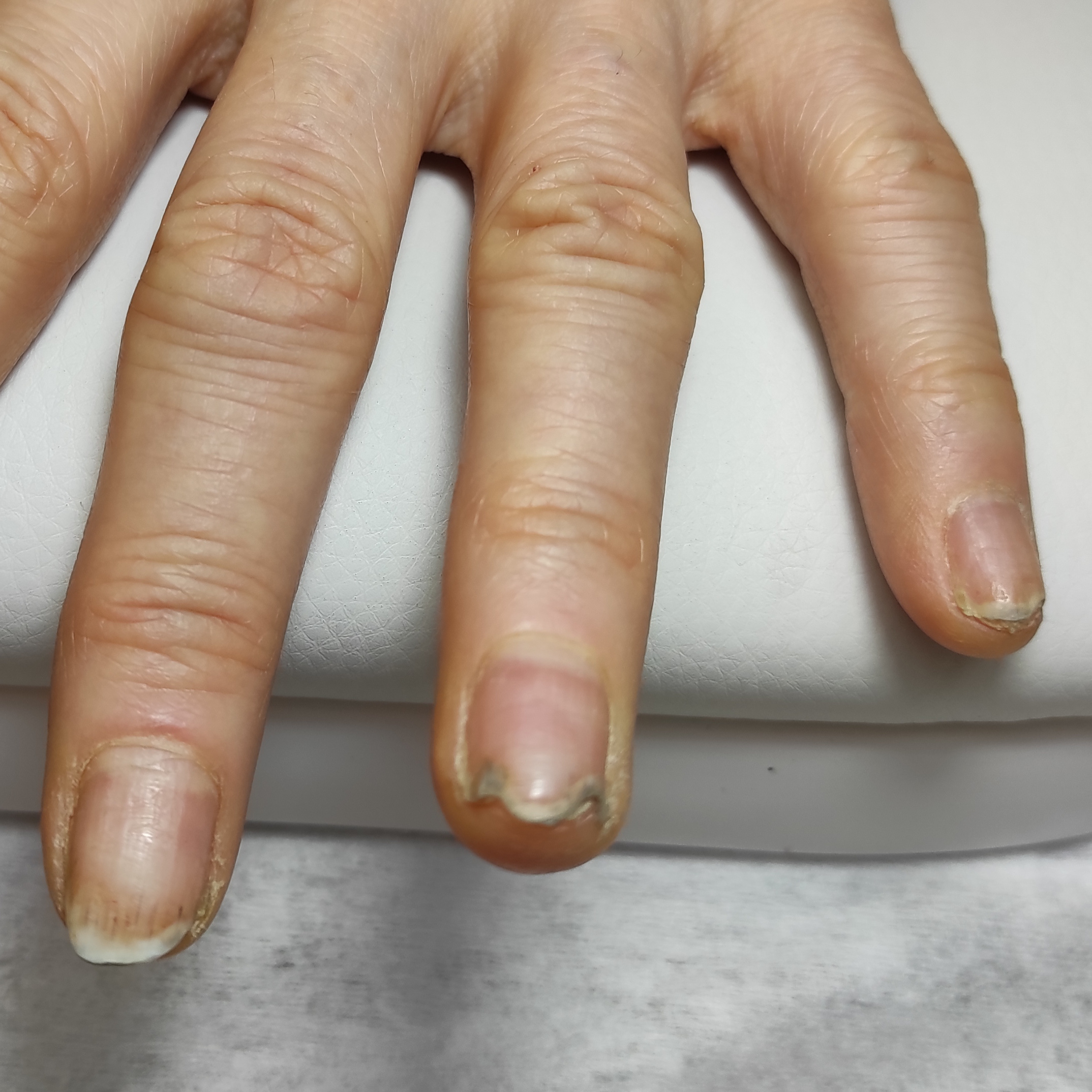 Обработка онихолизиса, онихогрифоза или микоза на руках 4-6 ногтей