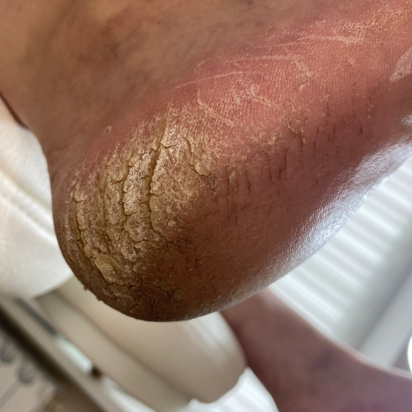 Педикюр повышенной сложности