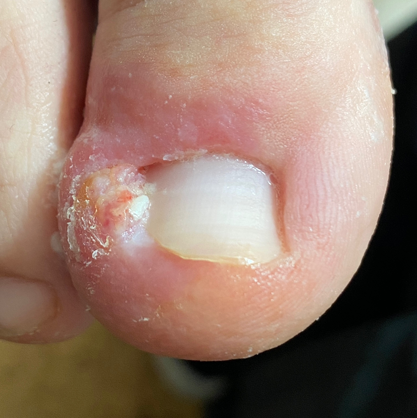 Обработка вросшего ногтя