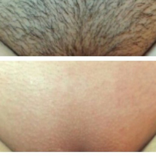 Бикини глубокое