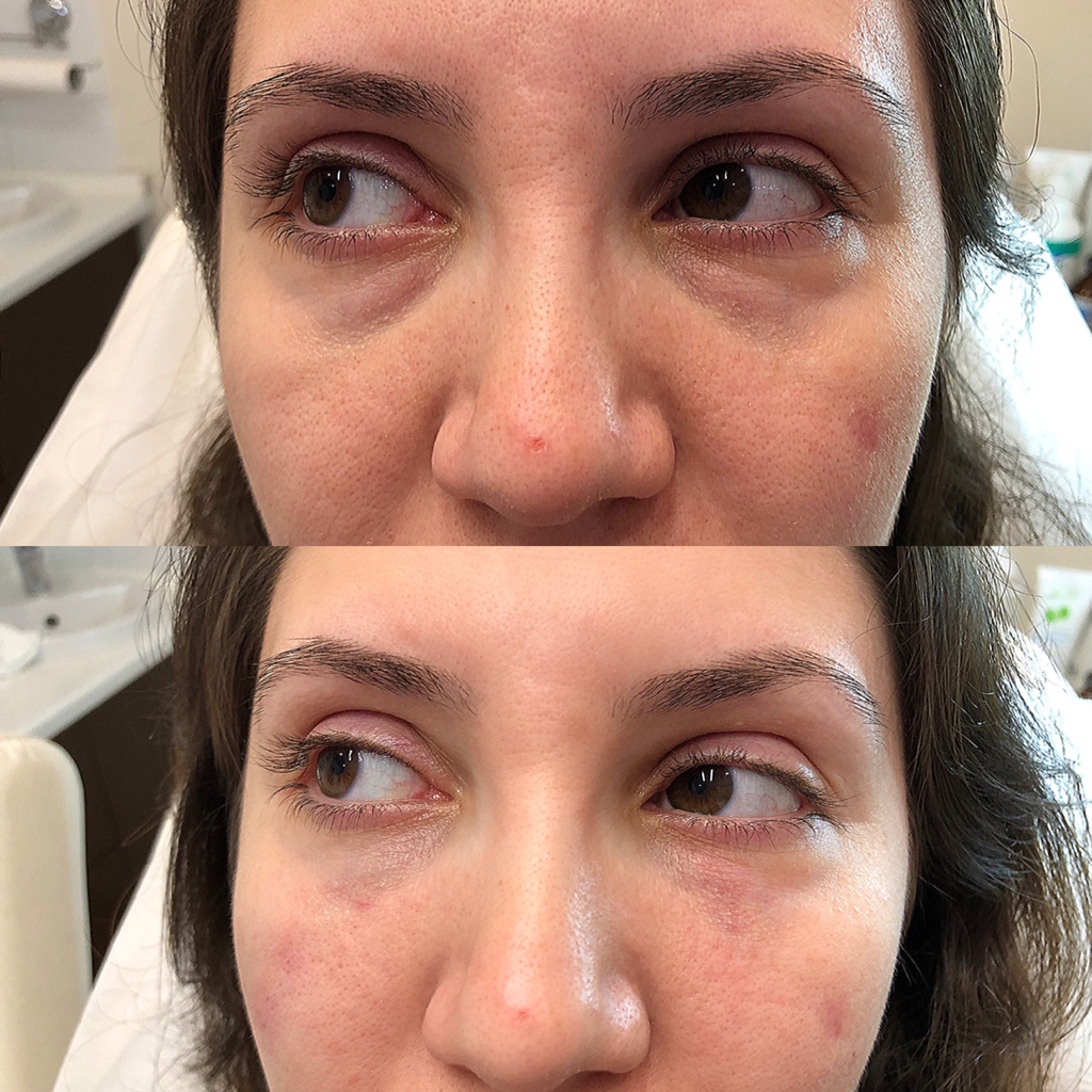 Коррекция носослезной борозды филлером