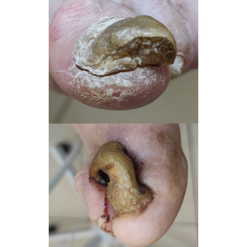 Сложный подологический педикюр